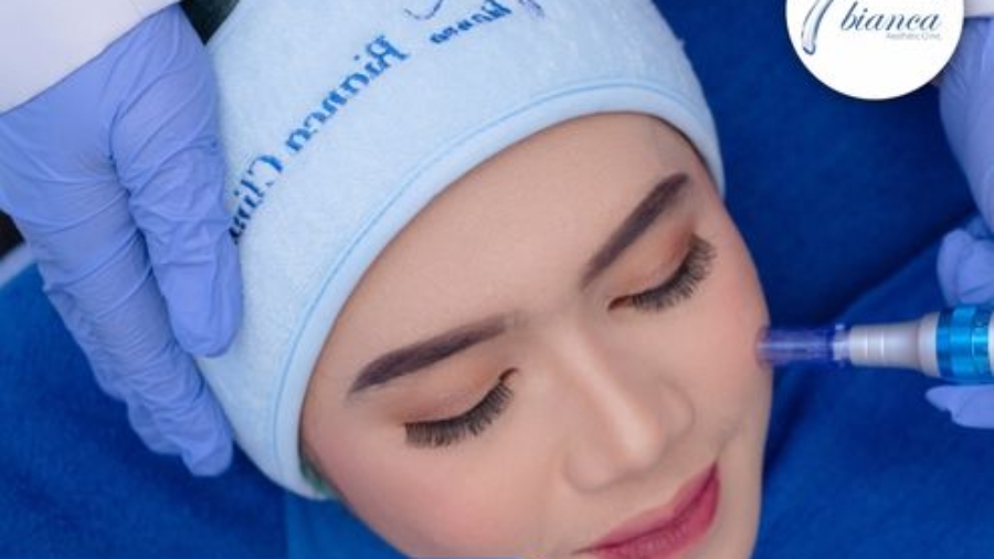 Microneedling