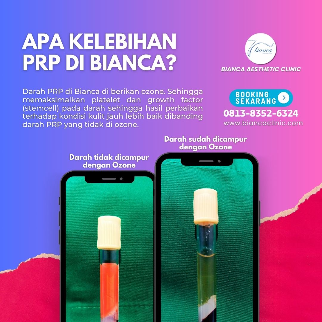 Darah PRP di Bianca di berikan ozone. Sehingga memaksimalkan platelet dan growth factor (stemcell) pada darah sehingga hasil perbaikan terhadap kondisi kulit jauh lebih baik dibanding darah PRP yang tidak di ozone.